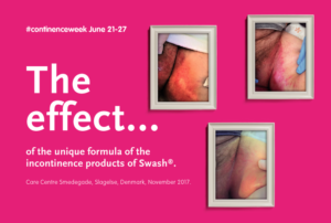 Perineal Skin Improvement in 3 days with Swash Perineum for IAD prevention
