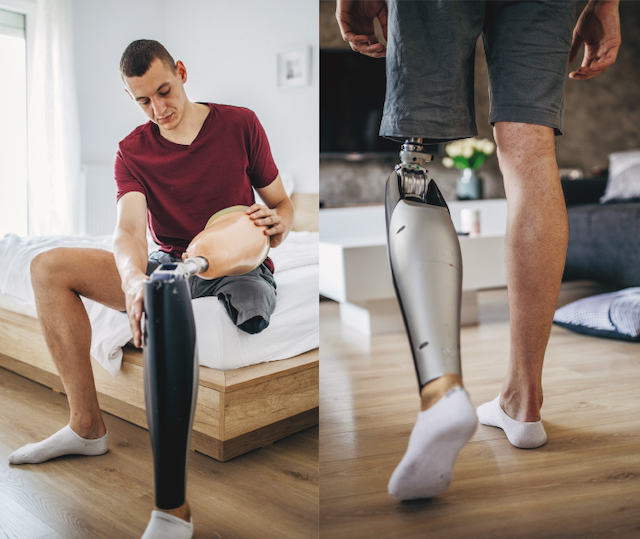 Guy with transfemoral prosthesis